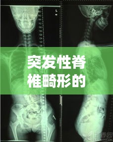突发性脊椎畸形的深度研究